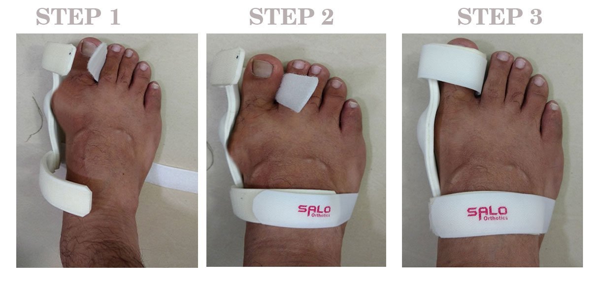 Hallux Valgus Splint (Bunion Splint) - Image 6